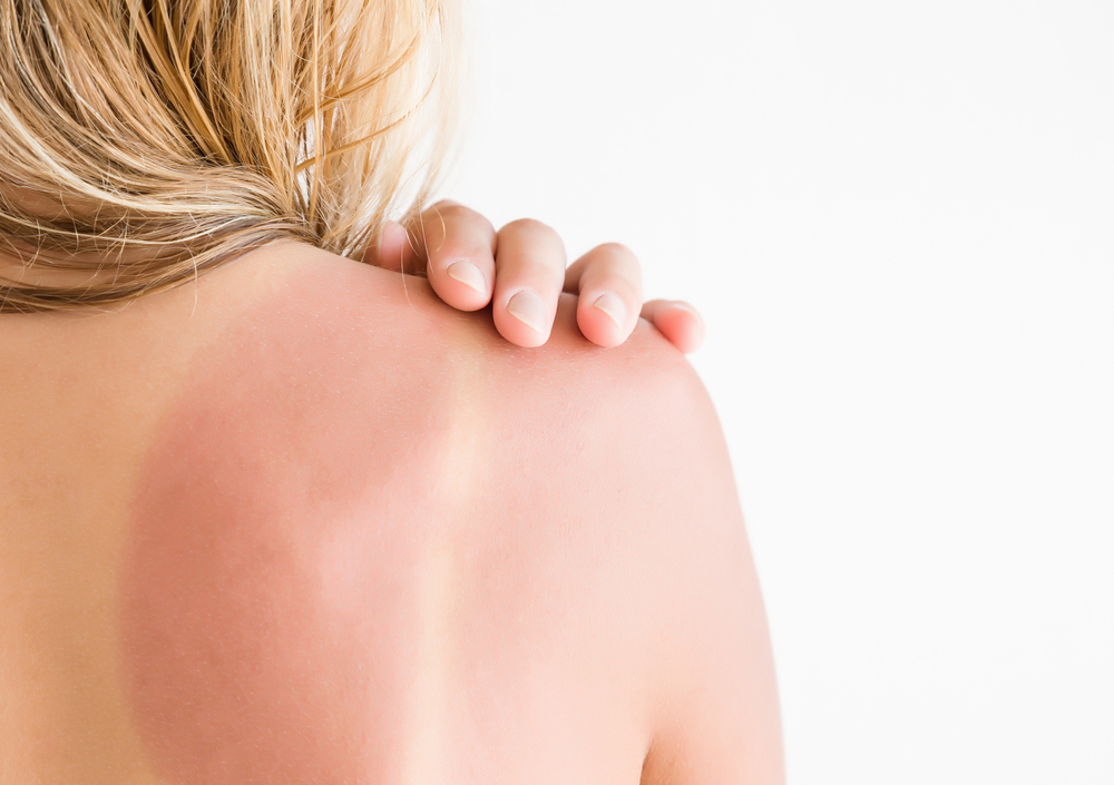 home remedies that can soothe your sunburn